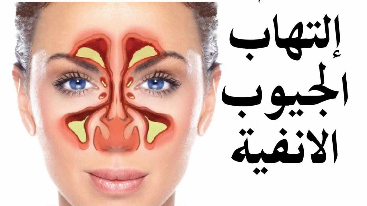 اسباب واعراض حساسية الجيوب الانفية وعلاجها