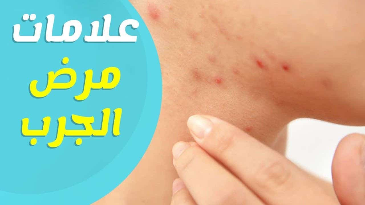 ما هي أسباب الجرب عند الإنسان