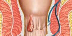 علاج البواسير وأعراضه وأسبابه