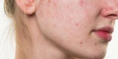 محلول أكني زنك Acne Zinc – لعلاج حب الشباب