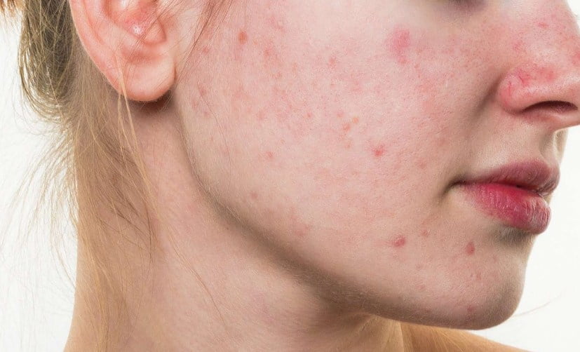 محلول أكني زنك Acne Zinc – لعلاج حب الشباب