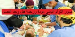 صور التوأم اليمني مودة ورحمة قبل وبعد الفصل
