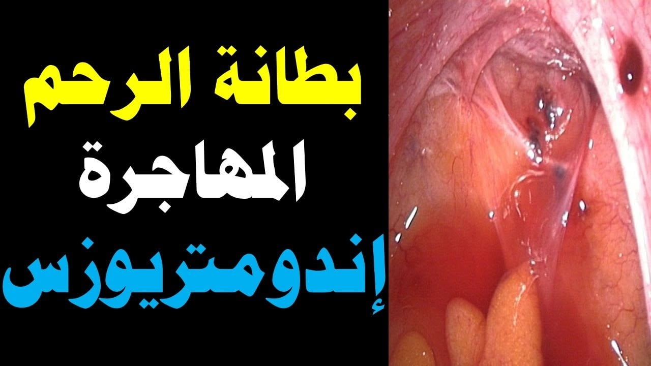 ما هي بطانة الرحم المهاجرة وما أعراضها واسبابها وطرق العلاج